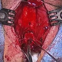 Excision and Primary Anastomotic Urethroplasty video image
