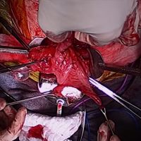 Minimally invasive continent catheterizable ileal cecocystoplasty thumbnail image