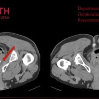 Posterior Urethroplasty after Radiation Treatment for Prostate Cancer 2018 image thumbnail