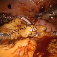 Robotic Buccal Mucosa Graft Ureteroplasty video image